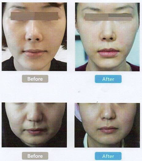 ไฮฟูรักษา