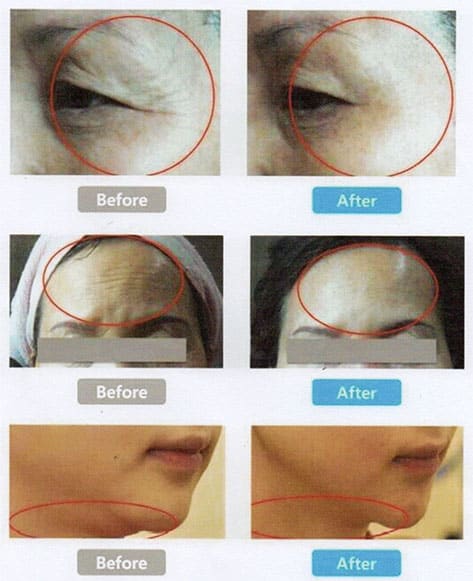 หางตา/ริ้วรอย/คาง