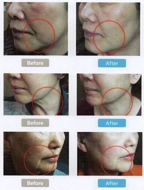 คางย้อย/มุมปาก